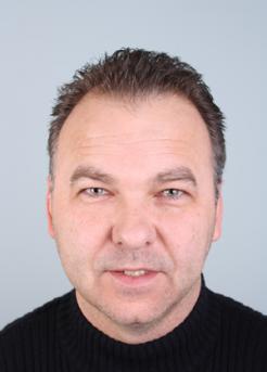Before Hair Transplant&nbsp;Temporal Hairline